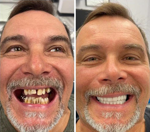 SmileShade - Camouflez rapidement les imperfections dentaires pour un sourire parfait