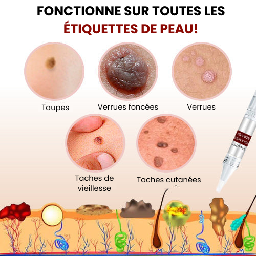 SkinClear™ - Dissolvant de verrues et de taches (1+1 GRATUIT)
