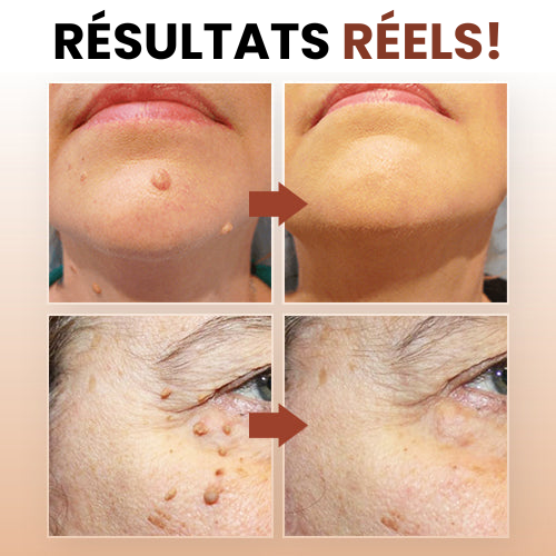 SkinClear™ - Dissolvant de verrues et de taches (1+1 GRATUIT)